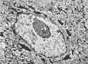 F, 11y. | ichthyosis hystrix type Curth-Macklin F, 11y. | ichthyosis hystrix type Curth-Macklin
